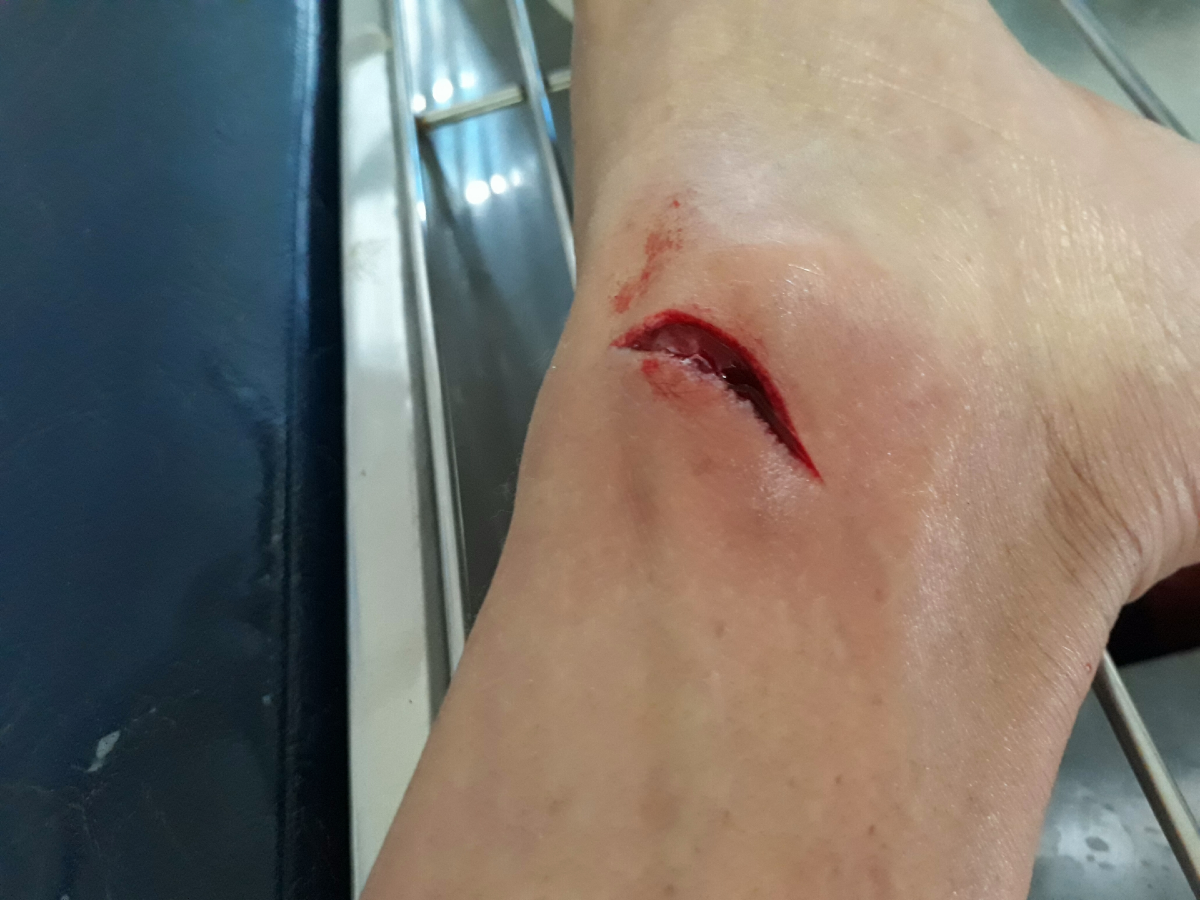 Laceration To Leg